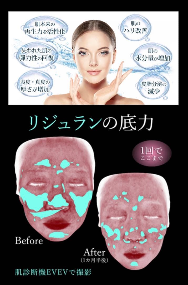 すずき　ダーマペン本体セット、リジュラン、グルタチオンスキンブースター